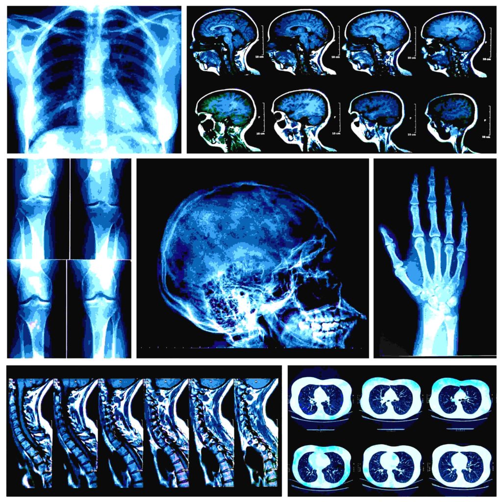 X Ray of Broken Bones